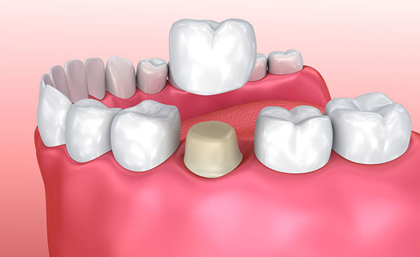 Cottonwood Dentists dental crown placement