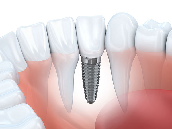 Maple Ridge Dental Implant